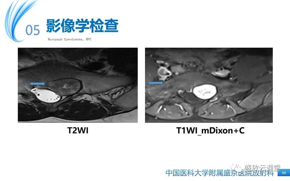 影像PPT - 【PPT】圆锥马尾型粘液乳头型室管膜瘤-39