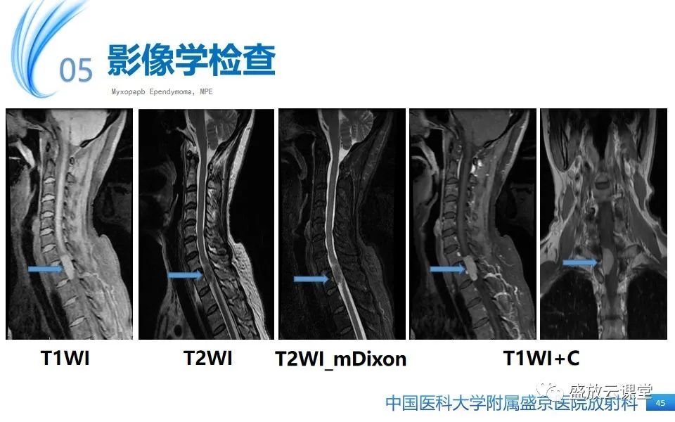 影像PPT - 【PPT】圆锥马尾型粘液乳头型室管膜瘤-45