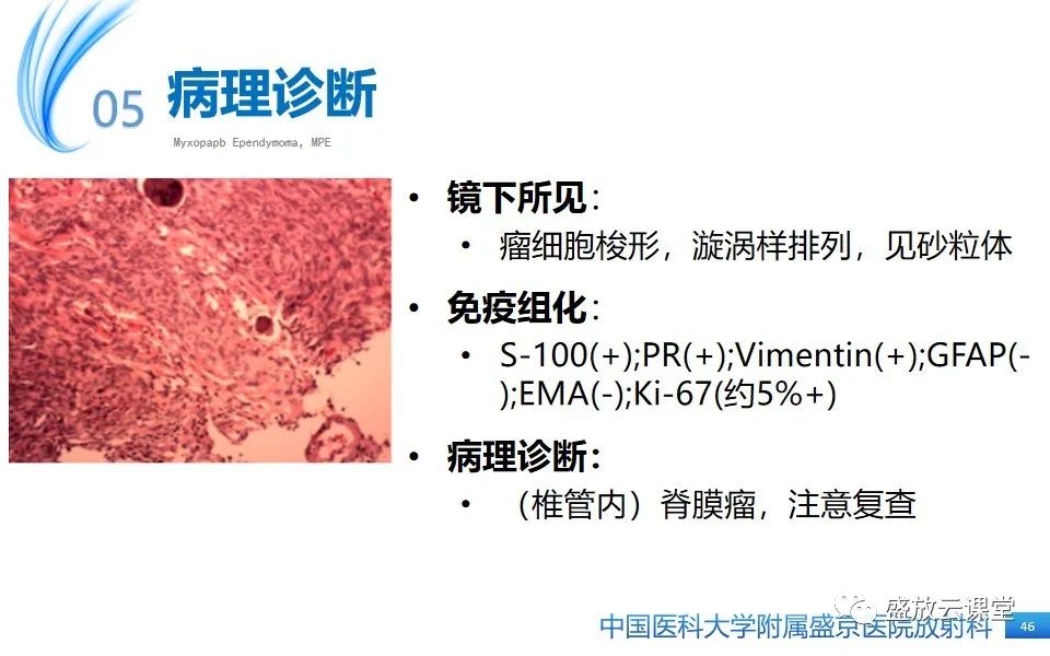 影像PPT - 【PPT】圆锥马尾型粘液乳头型室管膜瘤-46