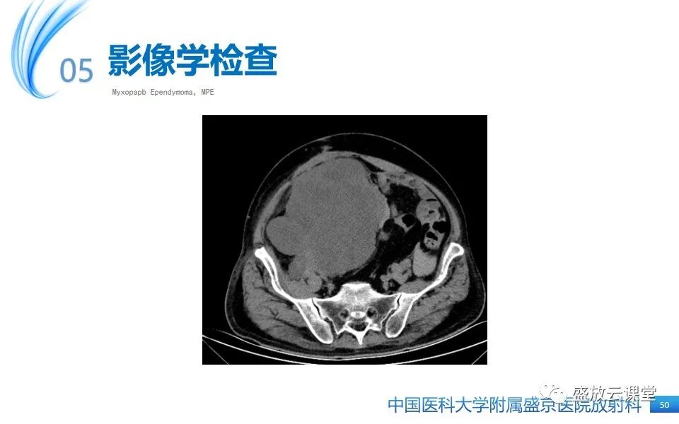 影像PPT - 【PPT】圆锥马尾型粘液乳头型室管膜瘤-50