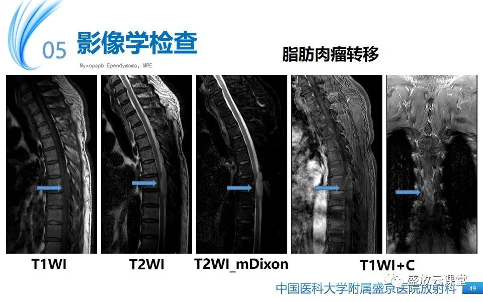 影像PPT - 【PPT】圆锥马尾型粘液乳头型室管膜瘤-49