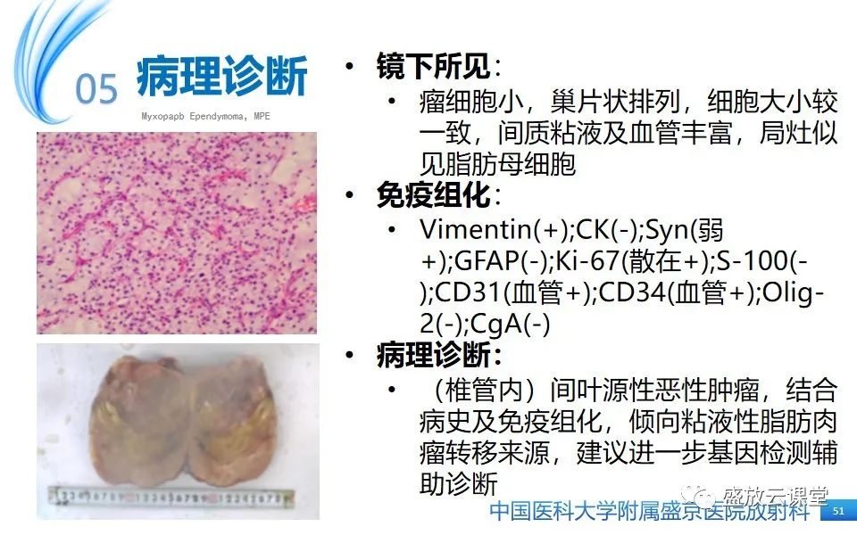 影像PPT - 【PPT】圆锥马尾型粘液乳头型室管膜瘤-51