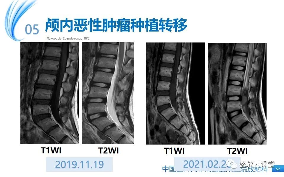 影像PPT - 【PPT】圆锥马尾型粘液乳头型室管膜瘤-52