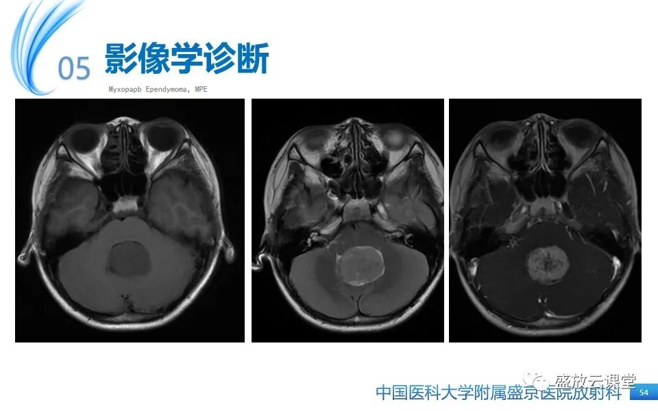 影像PPT - 【PPT】圆锥马尾型粘液乳头型室管膜瘤-54