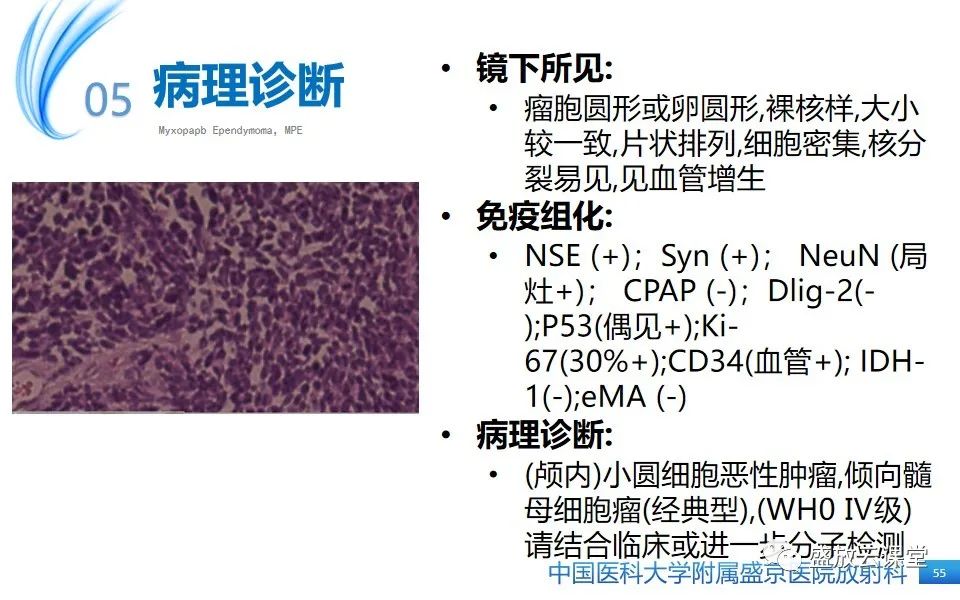 影像PPT - 【PPT】圆锥马尾型粘液乳头型室管膜瘤-55