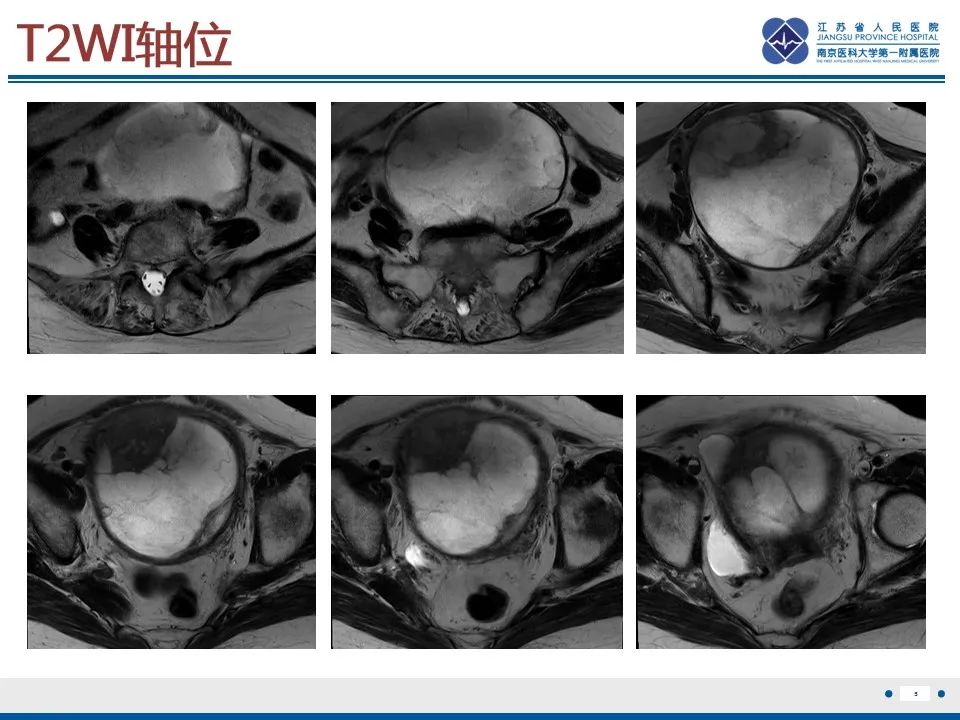 影像PPT - 【PPT】高级别子宫内膜间质肉瘤-6