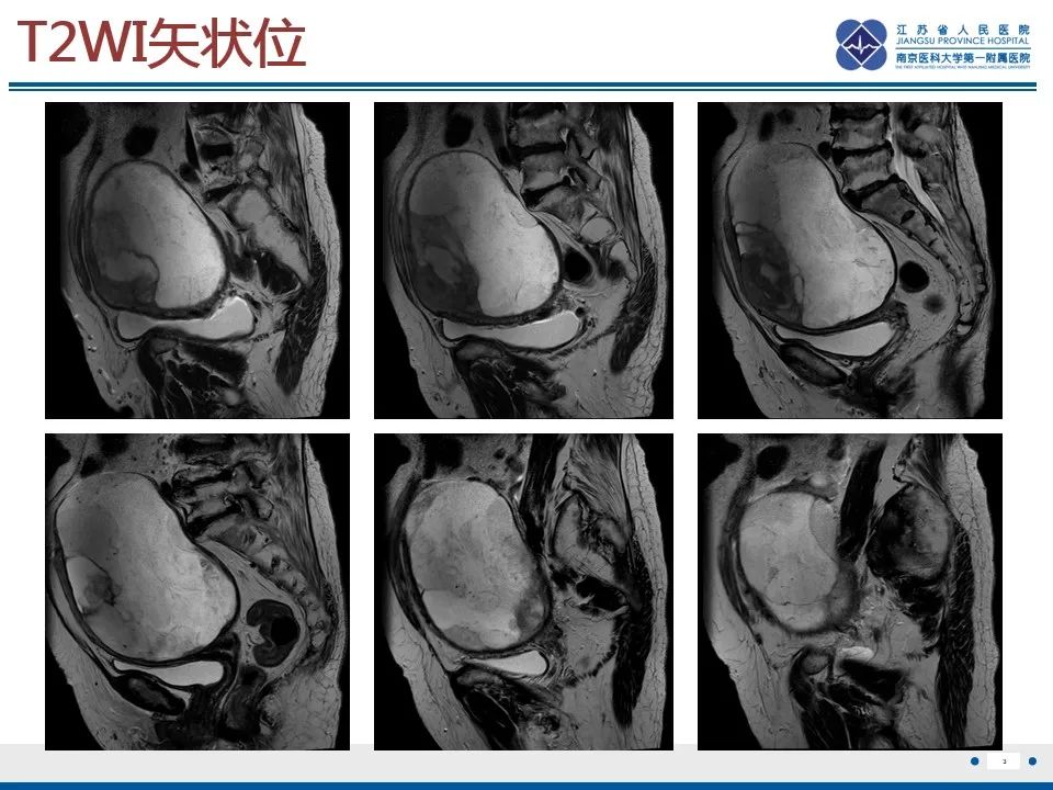 影像PPT - 【PPT】高级别子宫内膜间质肉瘤-4