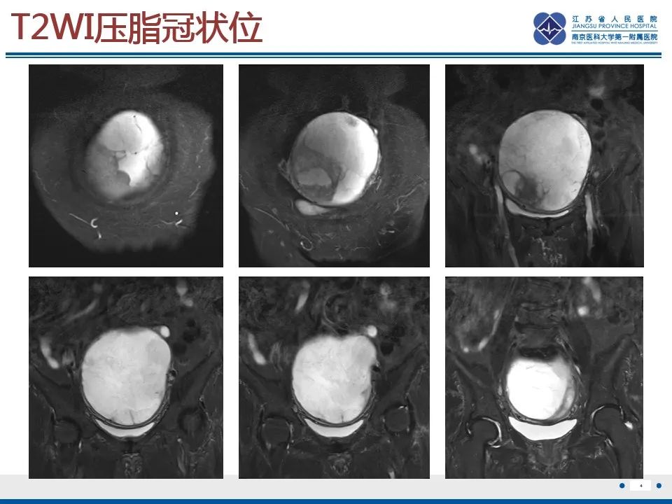 影像PPT - 【PPT】高级别子宫内膜间质肉瘤-5