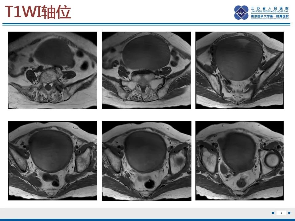 影像PPT - 【PPT】高级别子宫内膜间质肉瘤-7