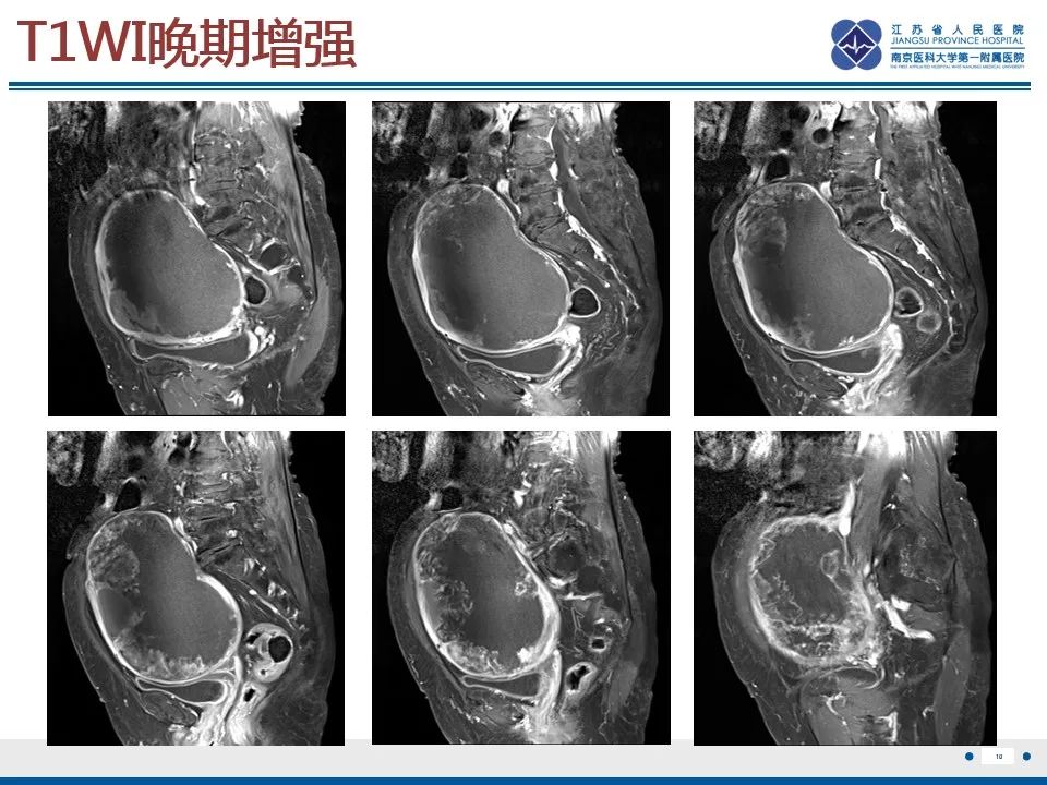 影像PPT - 【PPT】高级别子宫内膜间质肉瘤-11