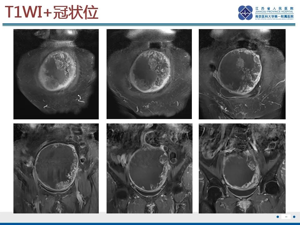 影像PPT - 【PPT】高级别子宫内膜间质肉瘤-12