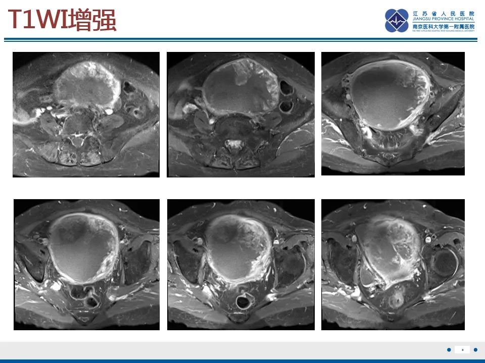 影像PPT - 【PPT】高级别子宫内膜间质肉瘤-9
