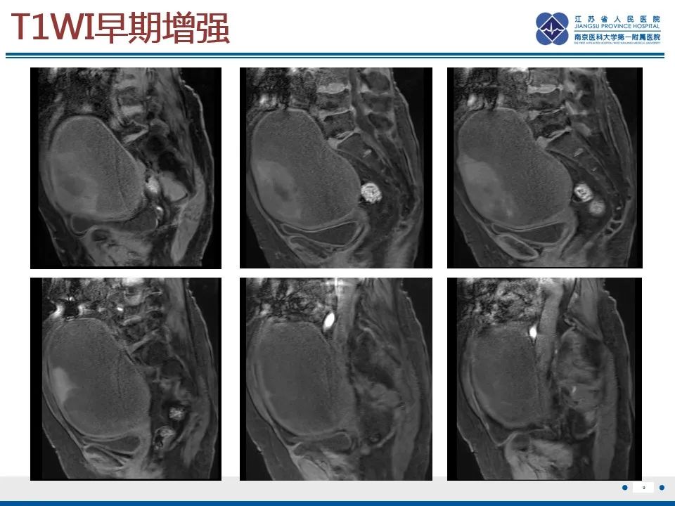 影像PPT - 【PPT】高级别子宫内膜间质肉瘤-10