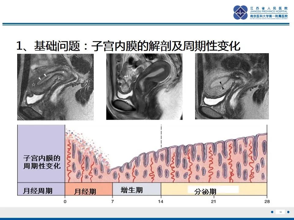 影像PPT - 【PPT】高级别子宫内膜间质肉瘤-15