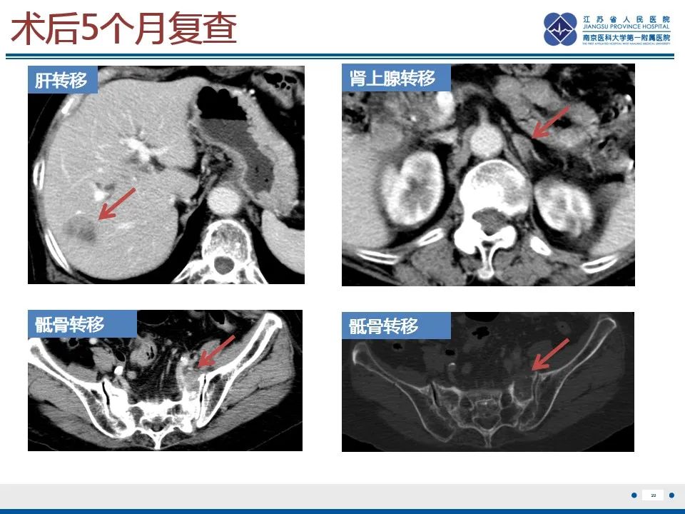 影像PPT - 【PPT】高级别子宫内膜间质肉瘤-21