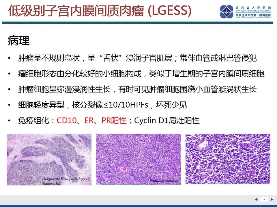 影像PPT - 【PPT】高级别子宫内膜间质肉瘤-27