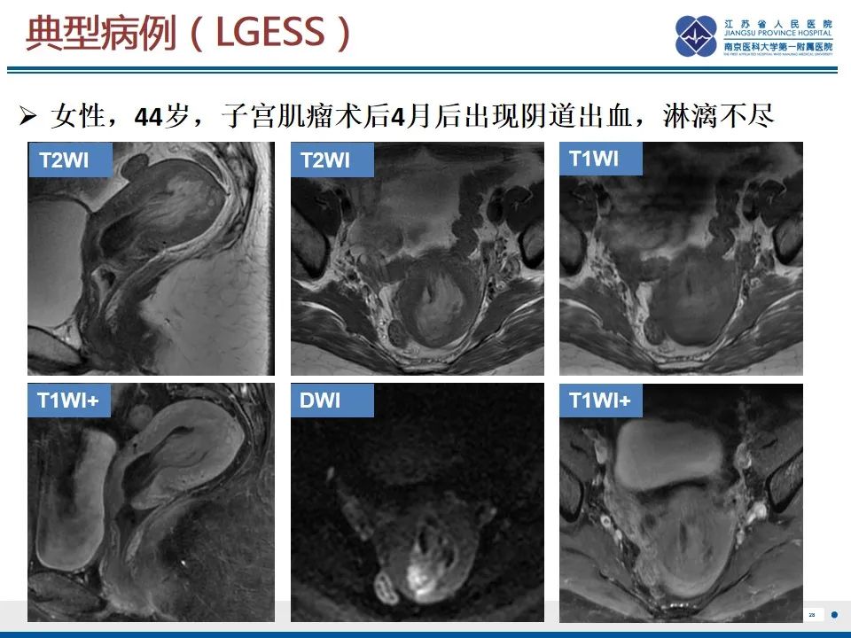 影像PPT - 【PPT】高级别子宫内膜间质肉瘤-29