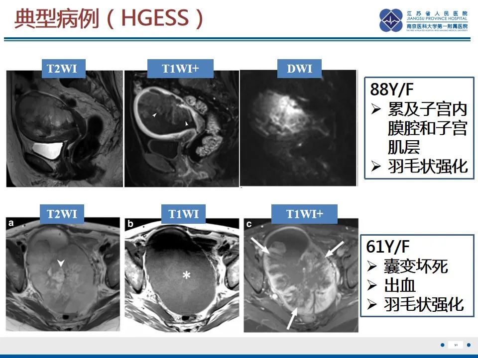 影像PPT - 【PPT】高级别子宫内膜间质肉瘤-32