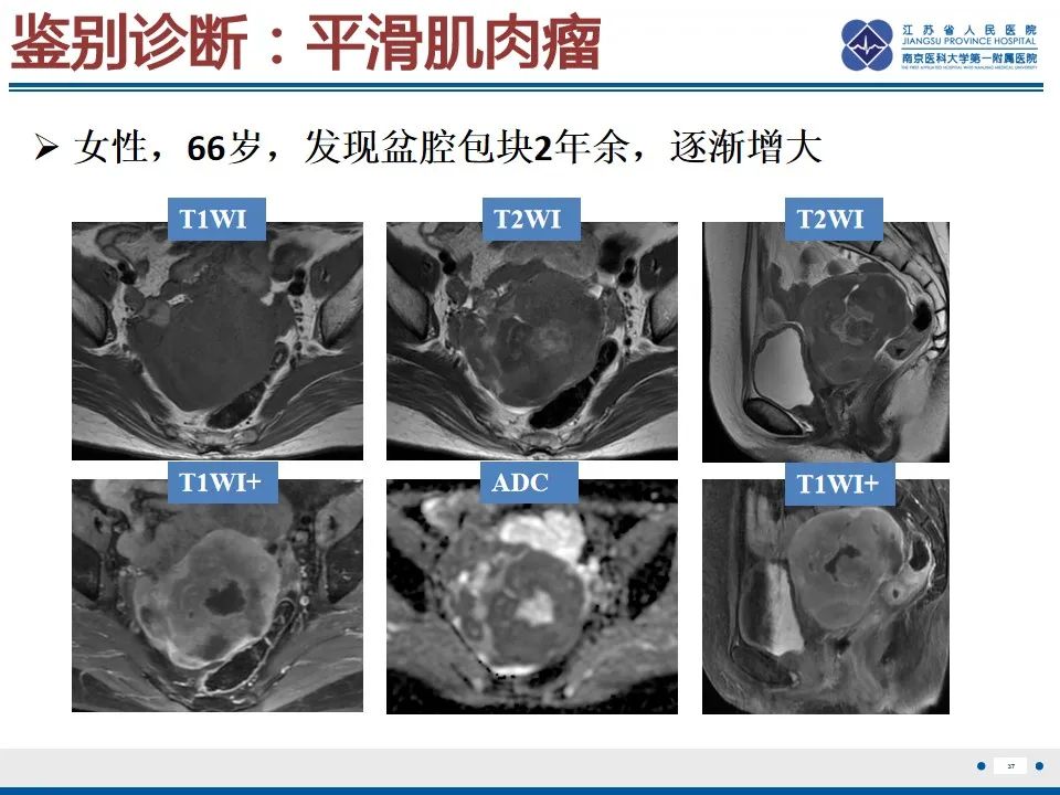 影像PPT - 【PPT】高级别子宫内膜间质肉瘤-38