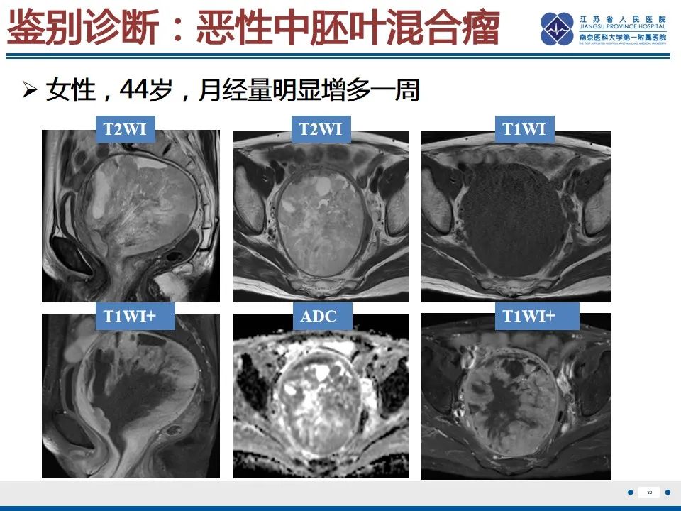 影像PPT - 【PPT】高级别子宫内膜间质肉瘤-40