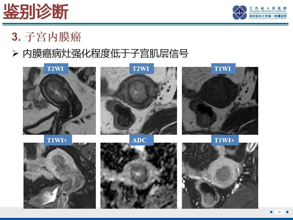 影像PPT - 【PPT】高级别子宫内膜间质肉瘤-41