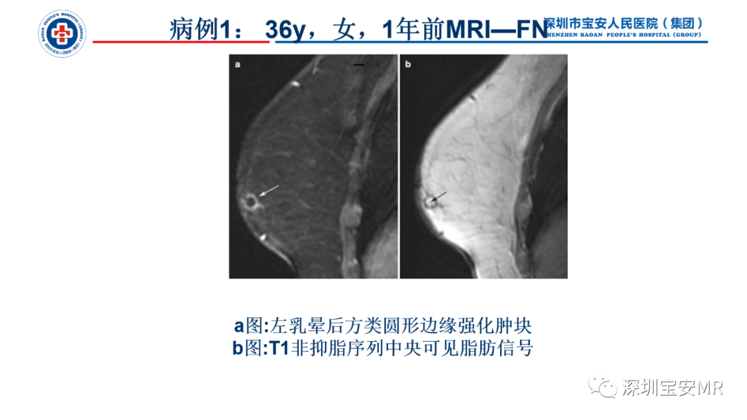 影像PPT - 【PPT】乳腺脂肪(Fat Necrosis)坏死影像表现-10