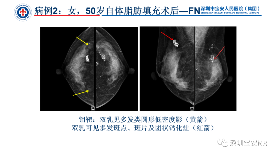 影像PPT - 【PPT】乳腺脂肪(Fat Necrosis)坏死影像表现-11