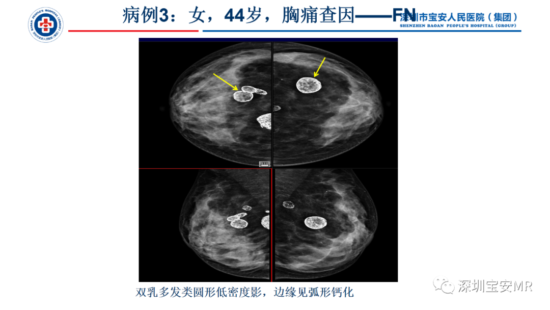 影像PPT - 【PPT】乳腺脂肪(Fat Necrosis)坏死影像表现-12