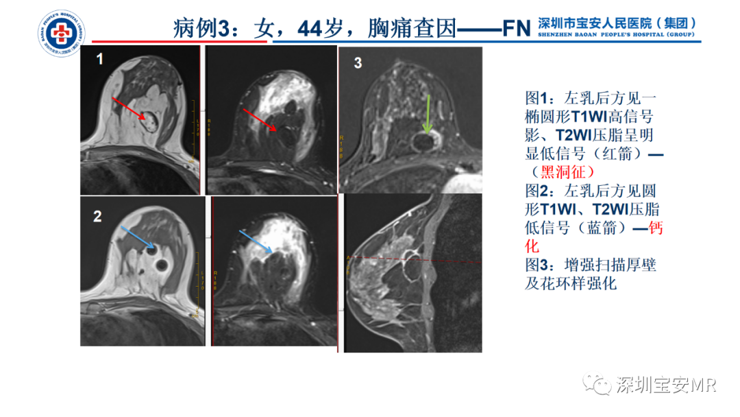 影像PPT - 【PPT】乳腺脂肪(Fat Necrosis)坏死影像表现-13