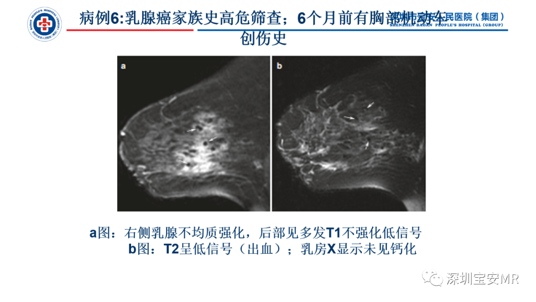 影像PPT - 【PPT】乳腺脂肪(Fat Necrosis)坏死影像表现-17
