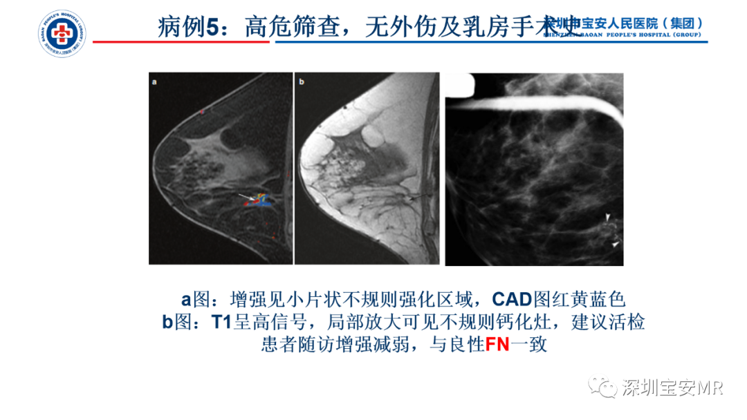 影像PPT - 【PPT】乳腺脂肪(Fat Necrosis)坏死影像表现-16