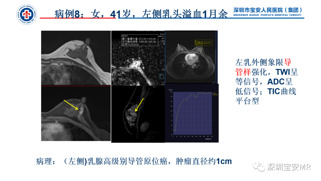 影像PPT - 【PPT】乳腺脂肪(Fat Necrosis)坏死影像表现-21