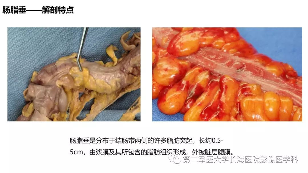 影像PPT - 【PPT】急性原发性肠脂垂炎CT诊断与鉴别诊断-4