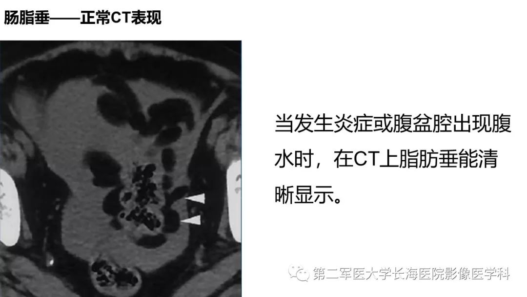影像PPT - 【PPT】急性原发性肠脂垂炎CT诊断与鉴别诊断-8