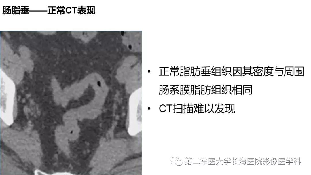 影像PPT - 【PPT】急性原发性肠脂垂炎CT诊断与鉴别诊断-7