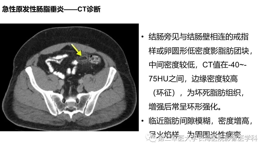 影像PPT - 【PPT】急性原发性肠脂垂炎CT诊断与鉴别诊断-17