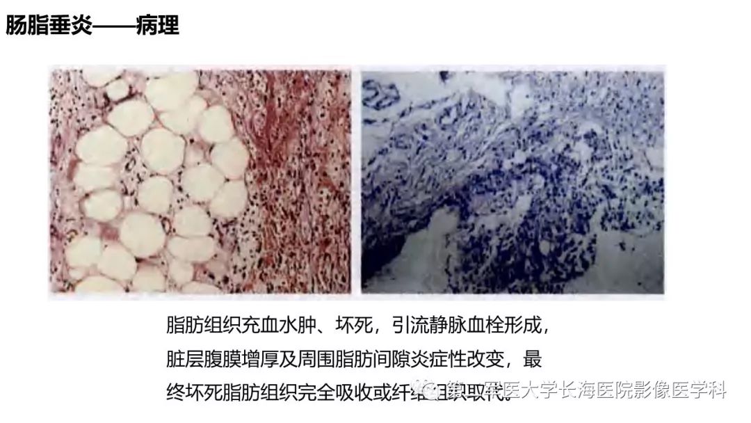 影像PPT - 【PPT】急性原发性肠脂垂炎CT诊断与鉴别诊断-13
