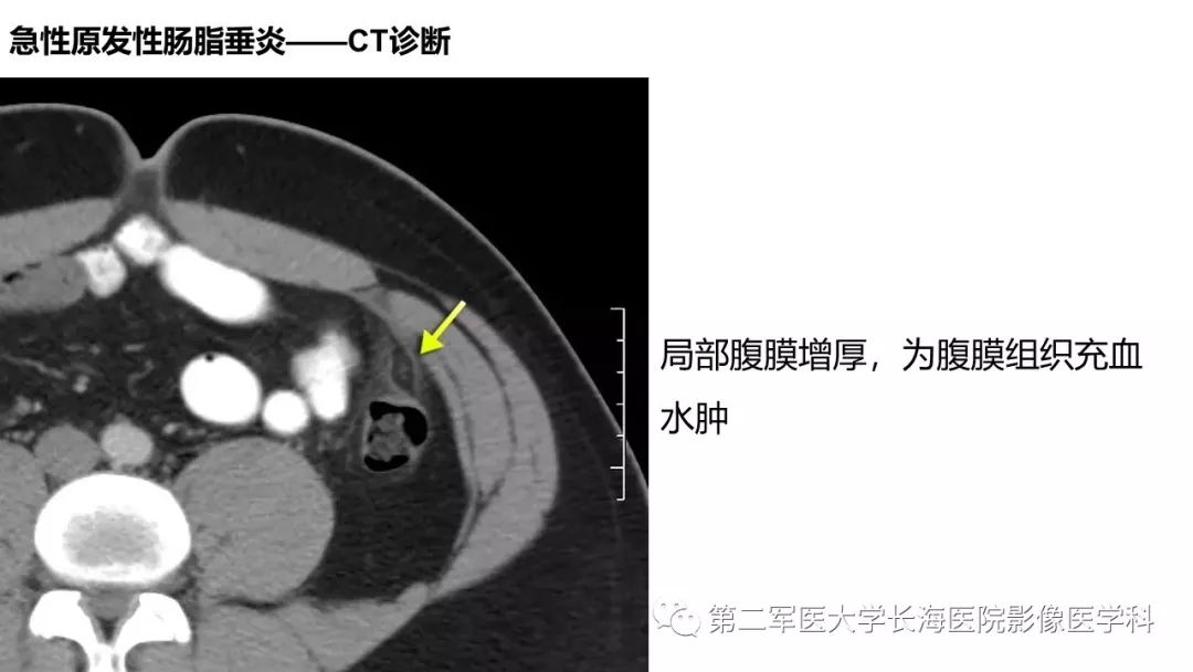 影像PPT - 【PPT】急性原发性肠脂垂炎CT诊断与鉴别诊断-21