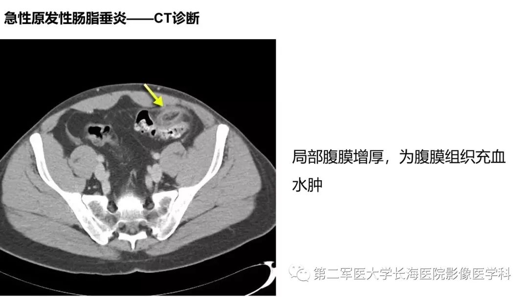 影像PPT - 【PPT】急性原发性肠脂垂炎CT诊断与鉴别诊断-20