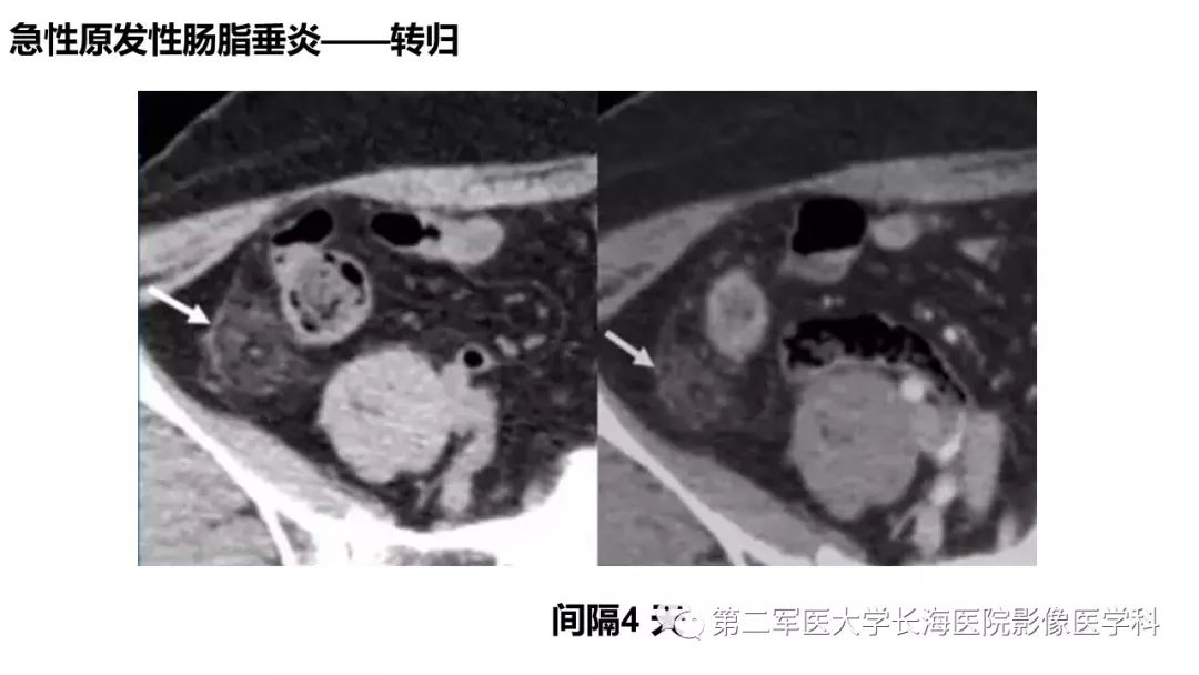 影像PPT - 【PPT】急性原发性肠脂垂炎CT诊断与鉴别诊断-24
