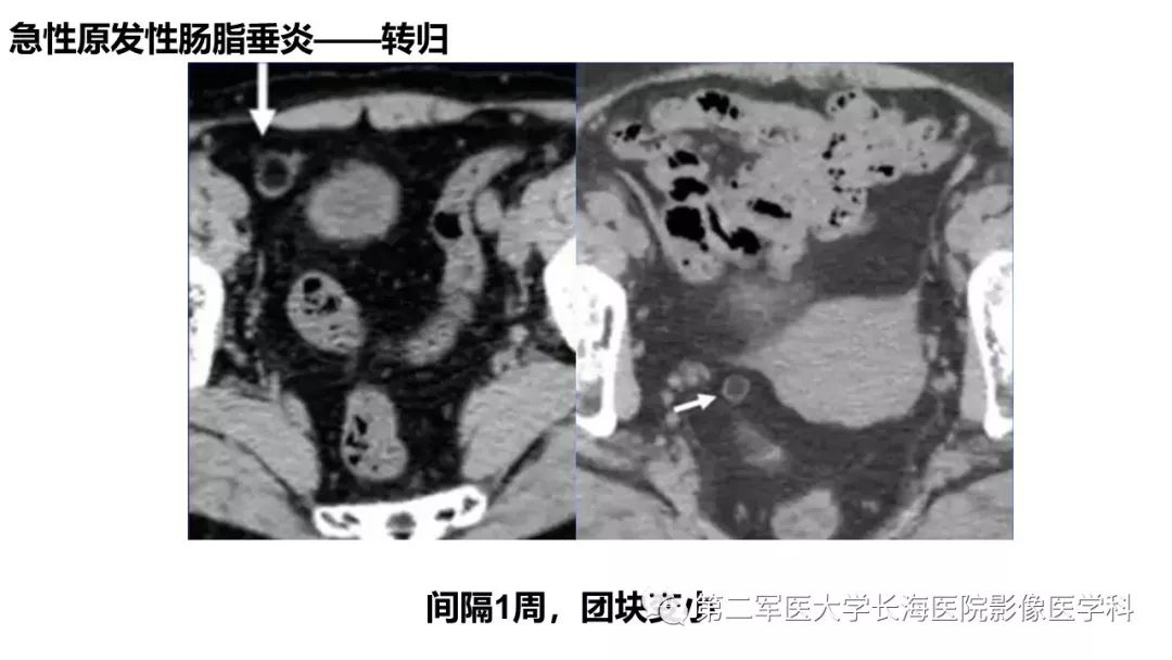 影像PPT - 【PPT】急性原发性肠脂垂炎CT诊断与鉴别诊断-25
