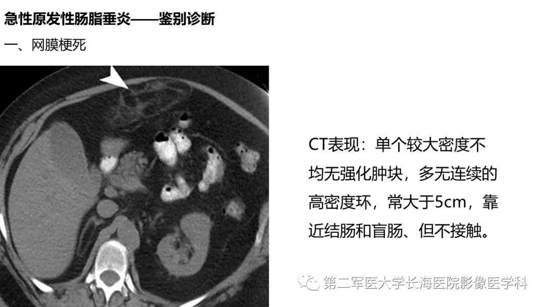 影像PPT - 【PPT】急性原发性肠脂垂炎CT诊断与鉴别诊断-28