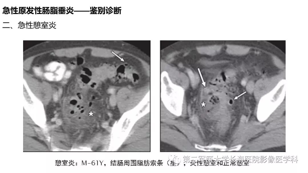 影像PPT - 【PPT】急性原发性肠脂垂炎CT诊断与鉴别诊断-31