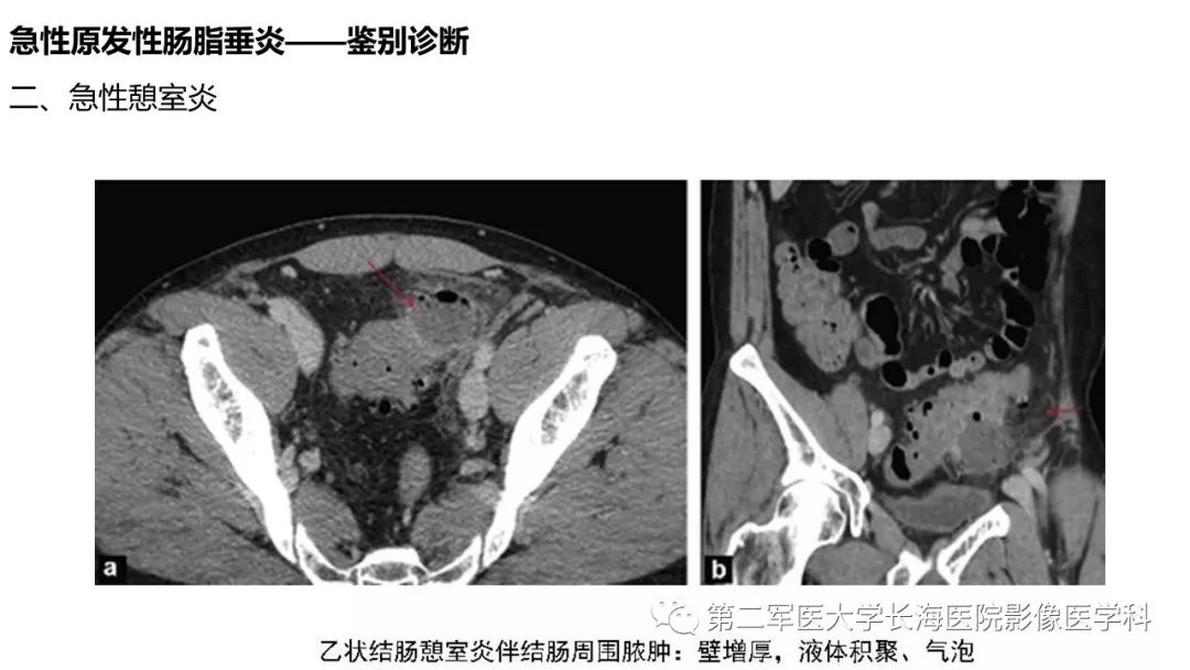 影像PPT - 【PPT】急性原发性肠脂垂炎CT诊断与鉴别诊断-32