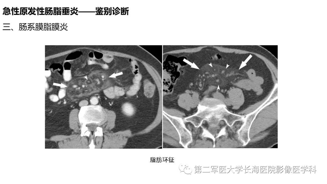 影像PPT - 【PPT】急性原发性肠脂垂炎CT诊断与鉴别诊断-35