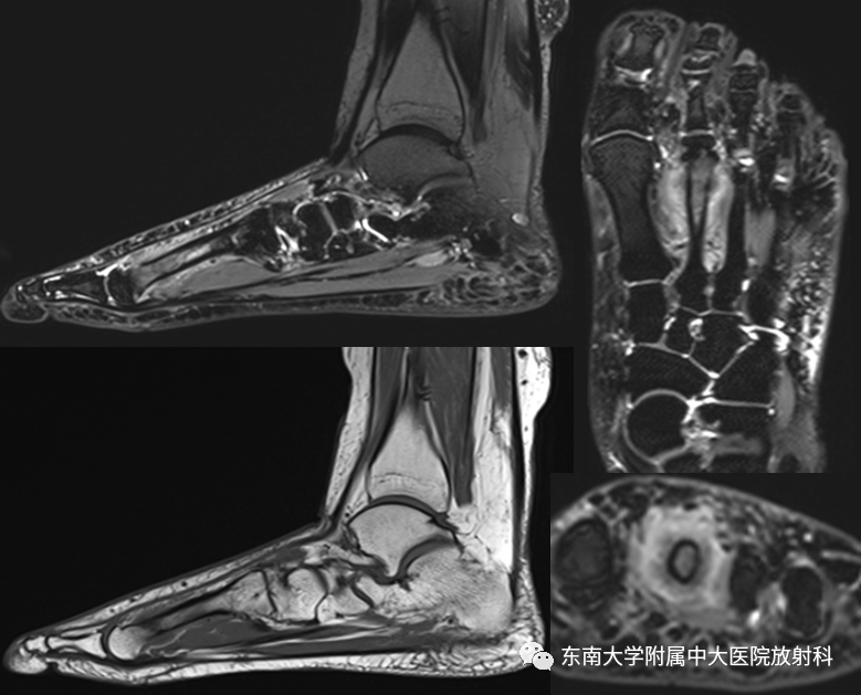 影像PPT - 【PPT】应力性骨折-2