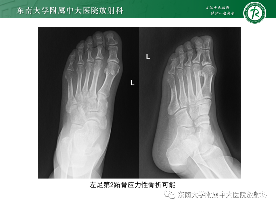 影像PPT - 【PPT】应力性骨折-3