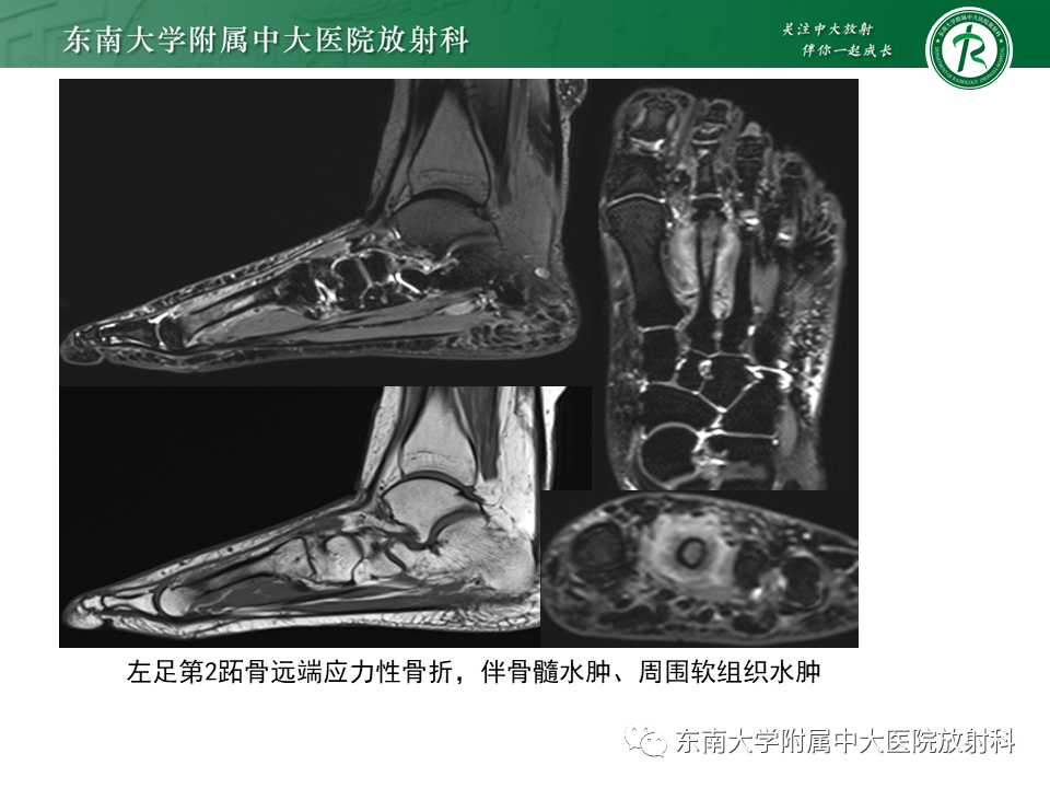 影像PPT - 【PPT】应力性骨折-4
