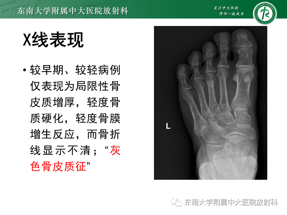 影像PPT - 【PPT】应力性骨折-14