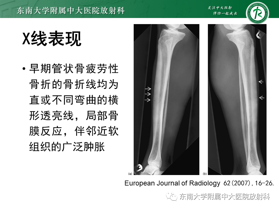 影像PPT - 【PPT】应力性骨折-15